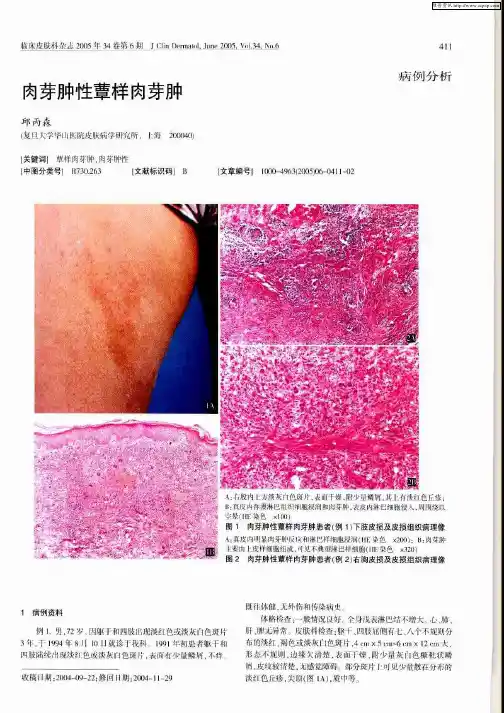 肉芽肿性蕈样肉芽肿