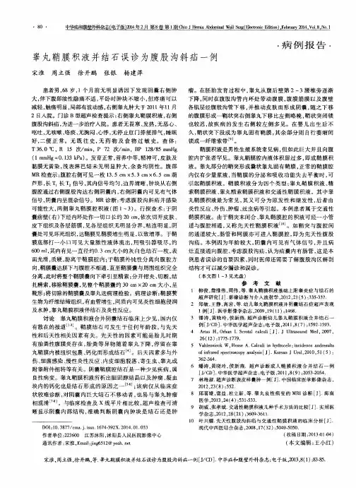 睾丸鞘膜积液并结石误诊为腹股沟斜疝一例
