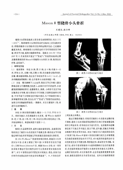 MasonⅢ型桡骨小头骨折