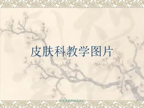 常见皮肤性病及治疗课件