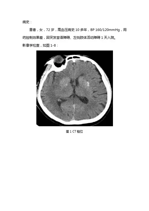 脑梗塞影像诊断及鉴别诊断(二)
