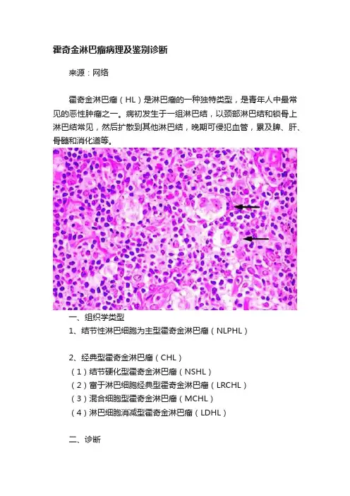 霍奇金淋巴瘤病理及鉴别诊断