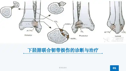 下胫腓联合韧带损伤ppt课件