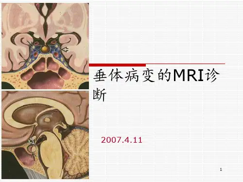 垂体病变的MRI诊断 ppt课件