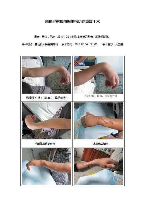 绕神经伤损申腕申指功能重建手术