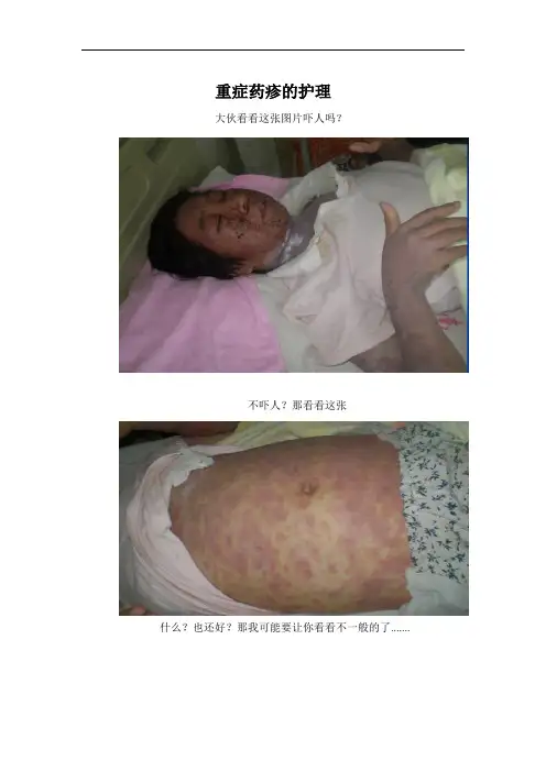 重症药疹的护理