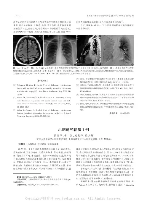 小脑神经鞘瘤1例