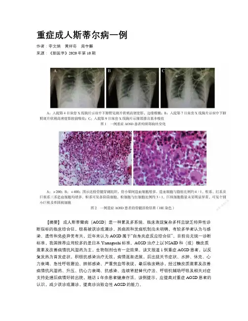 重症成人斯蒂尔病一例