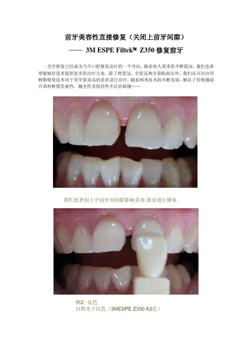 862-前牙美容性直接修复(关闭上前牙间隙)
