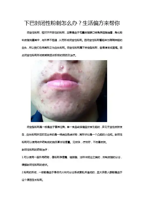 下巴封闭性粉刺怎么办？生活偏方来帮你