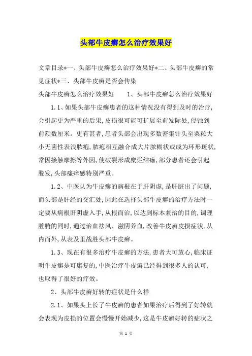 头部牛皮癣怎么治疗效果好