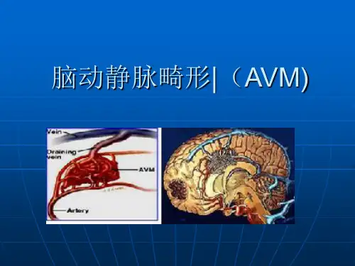 脑动静脉畸形影像诊断课件
