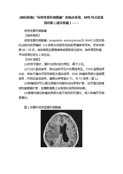 [神经影像]“间变性星形细胞瘤”的临床表现、MRI特点及鉴别诊断（建议收藏）~~~