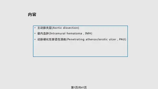 主动脉夹层诊断与鉴别诊断PPT课件