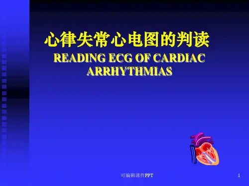 常见心律失常的心电图ppt课件