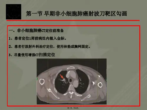 肺癌靶区勾画(一)