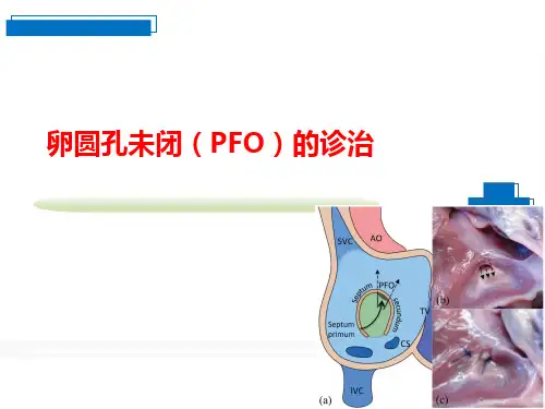 PFO的诊治