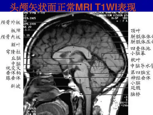 最新 头颅矢状面正常MRI