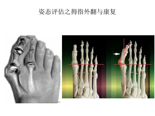 姿态评估之拇指外翻与康复