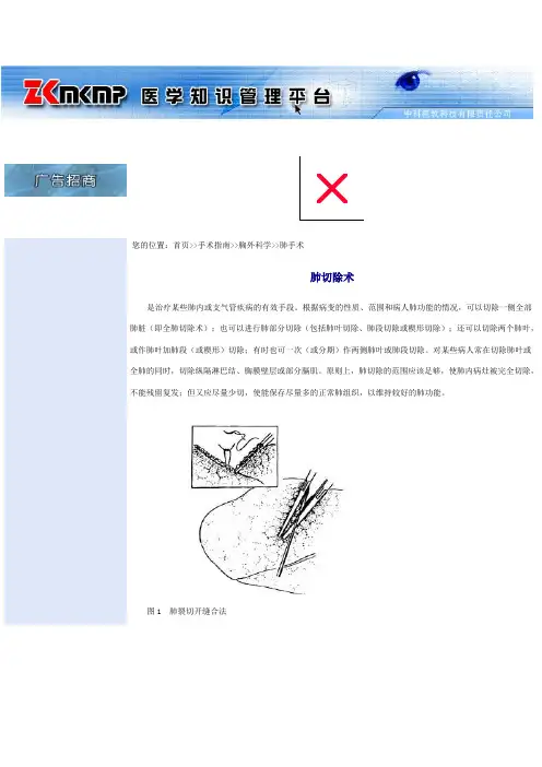 肺叶切除1