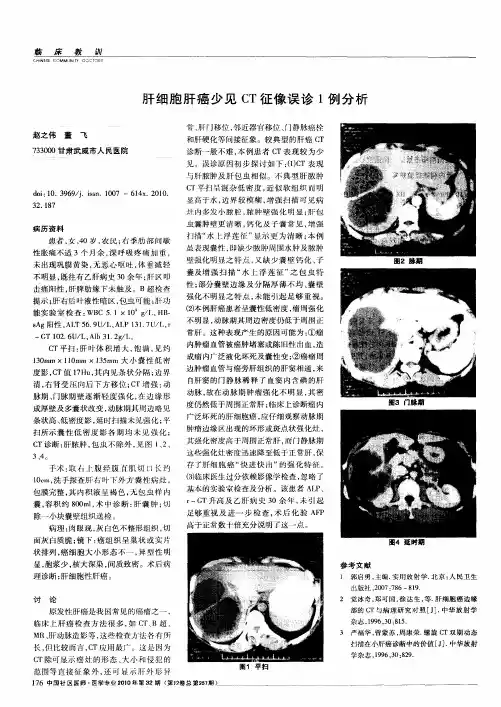 肝细胞肝癌少见CT征像误诊1例分析