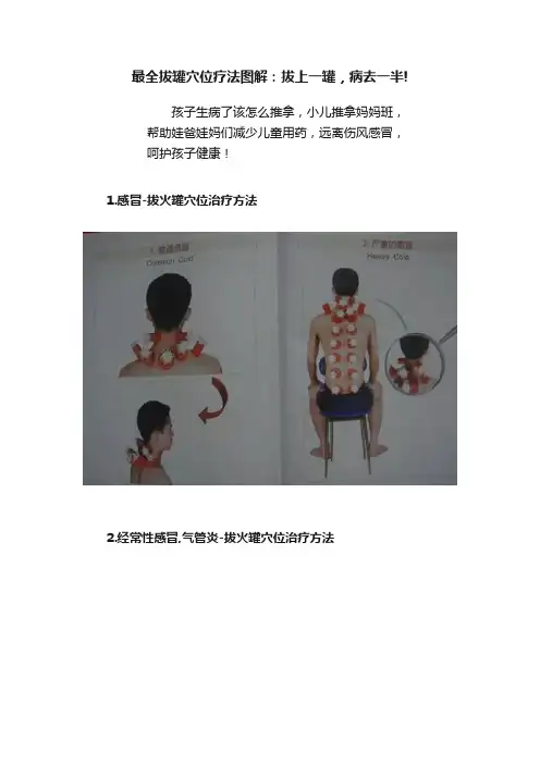 最全拔罐穴位疗法图解：拔上一罐，病去一半!