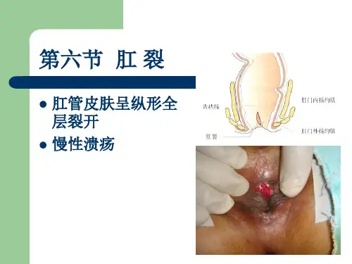中医外科学---3.肛裂