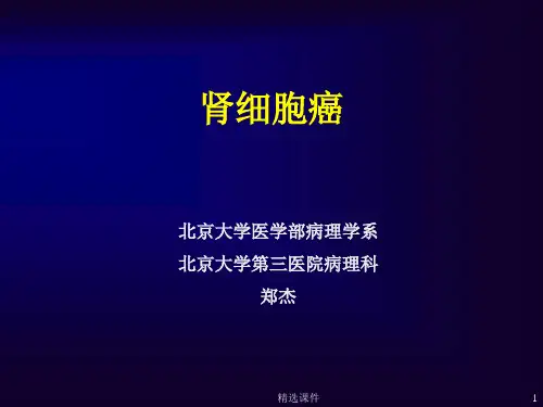 肾癌(病理)