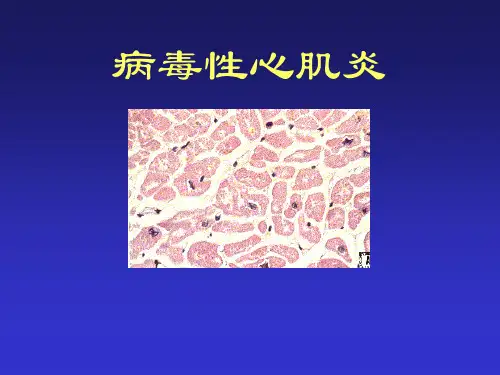 病毒性心肌炎的诊治PPT课件