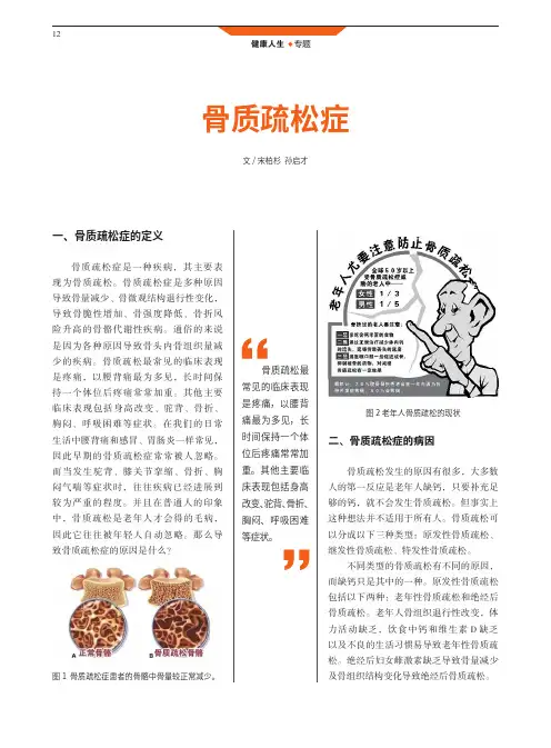 骨质疏松症