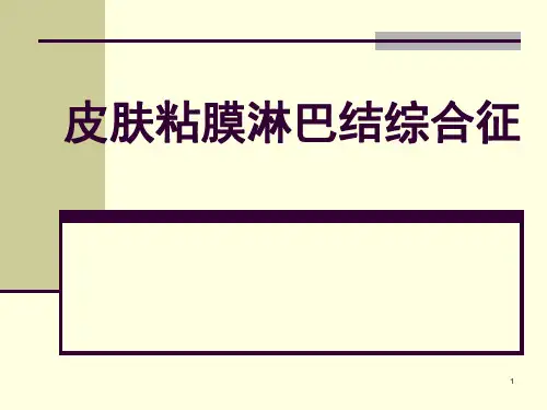 皮肤粘膜淋巴结综合征PPT课件