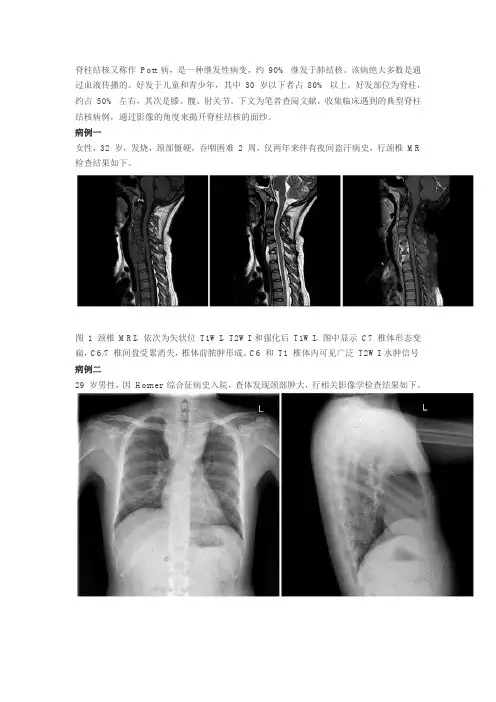 脊柱结核的影像学解析