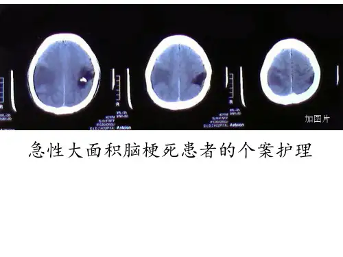 急性大面积脑梗死患者的个案护理ppt课件