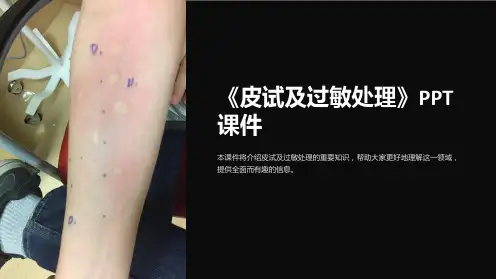 《皮试及过敏处理》课件