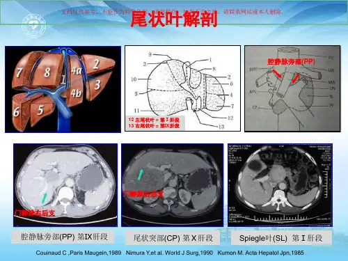 精准肝切除治疗尾状叶肝细胞癌经正中裂入路培训课件