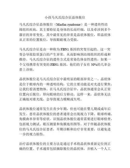 小孩马凡氏综合征晶体脱位