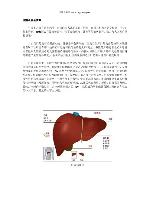 肝癌传染吗
