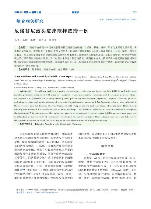 厄洛替尼致头皮痤疮样皮疹一例