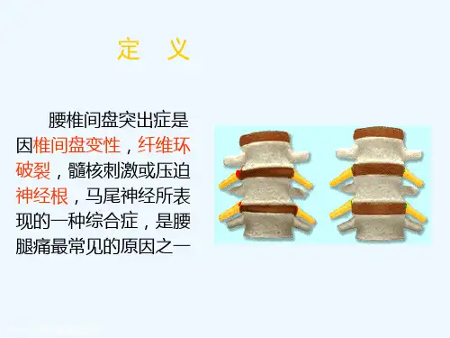 推拿学腰椎间盘突出课件