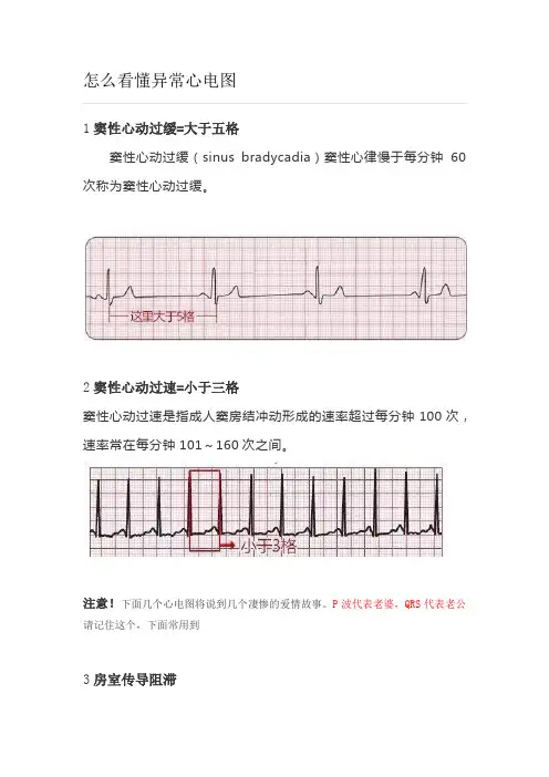 怎么看懂异常心电图