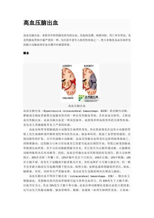 高血压脑出血