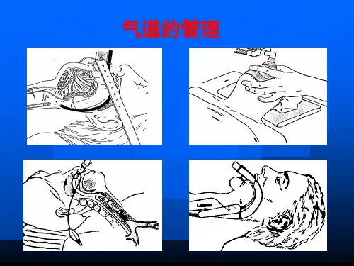 气管及支气管内插管术