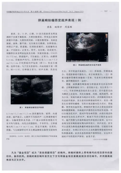 卵巢畸胎瘤恶变超声表现1例