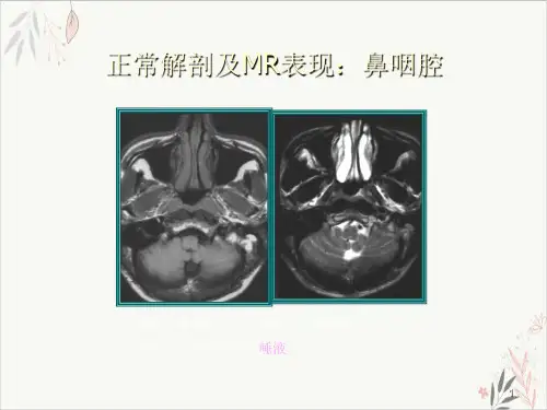 鼻咽癌MR诊断课件PPT