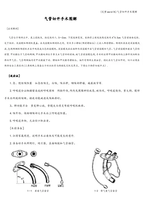 (完整word版)气管切开手术图解