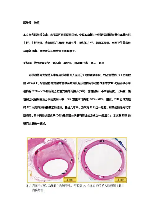 药物涂层支架