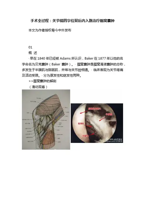 手术全过程：关节镜四字位双后内入路治疗腘窝囊肿