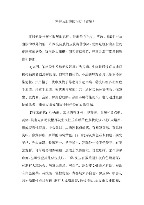 体癣及股癣的治疗(详解)