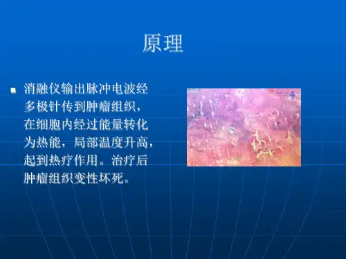 经皮穿刺射频消融治疗肺肿瘤课件
