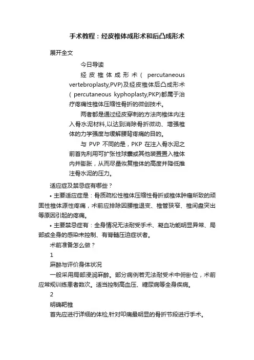 手术教程：经皮椎体成形术和后凸成形术